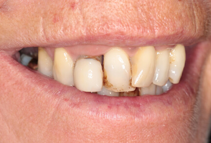 Close-up of a smile showing dental implants with visible gaps and discoloration before treatment.
