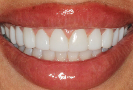 A close-up of a person's smile showing straight, bright white teeth after cosmetic dental treatment.