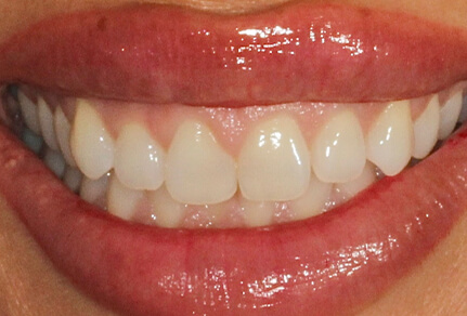 A close-up image of a person's smile showing teeth with dental bonding.