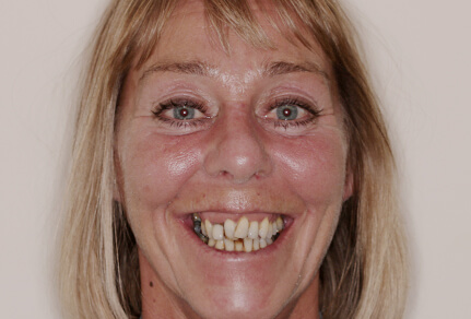 A close-up of a patient's smile showing damaged teeth, indicating the need for dental implants.
