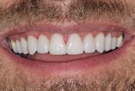 Close-up of a smile showing teeth enhanced with dental bonding for a more uniform and improved appearance.