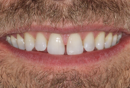 A close-up of a patient's smile showing well-aligned, white teeth after dental treatment.