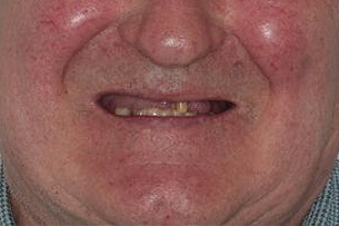 Close-up of a patient's smile showing uneven and missing teeth before dental treatment.