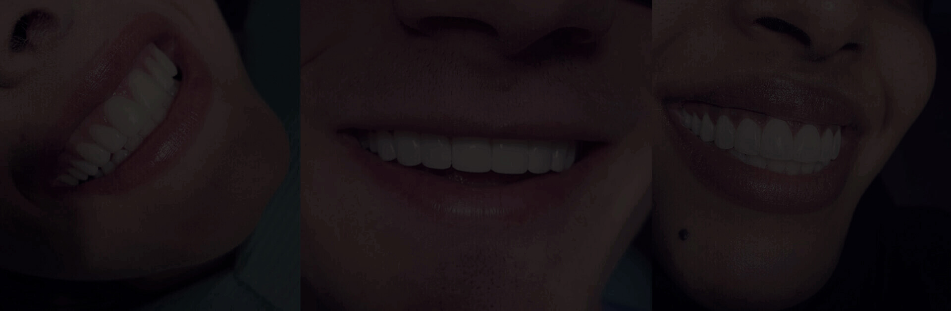 Collage of close-up smiles showing well-aligned and bright teeth.