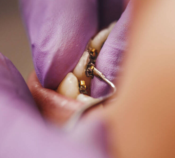 Lingual Braces Brentwood, Essex - Smile HQ