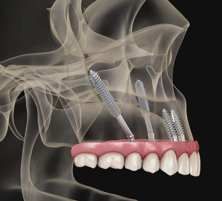 Zygomatic Implants Brentwood, Essex - Smile HQ