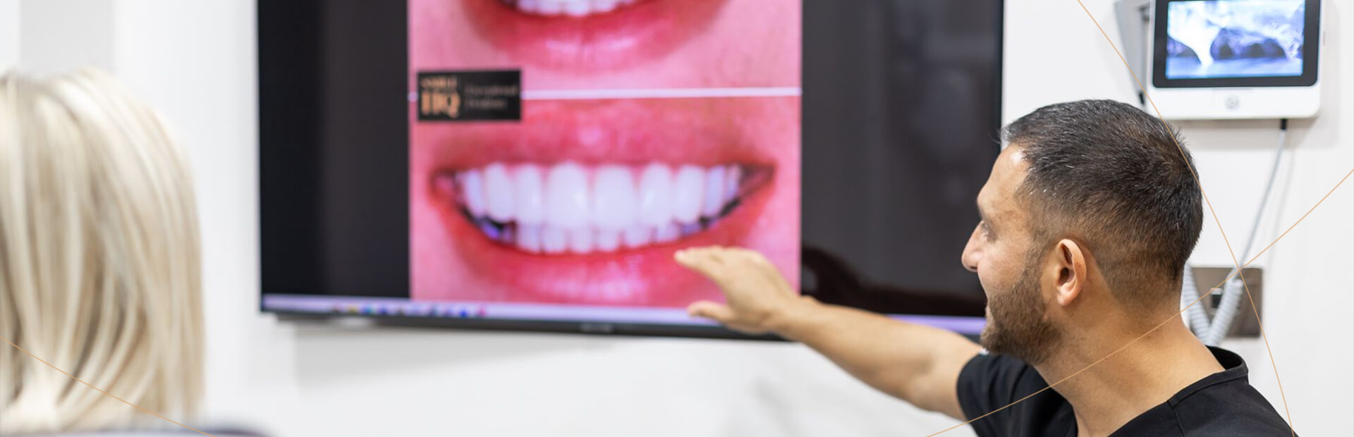 Veneers Brentwood, Essex - Smile HQ