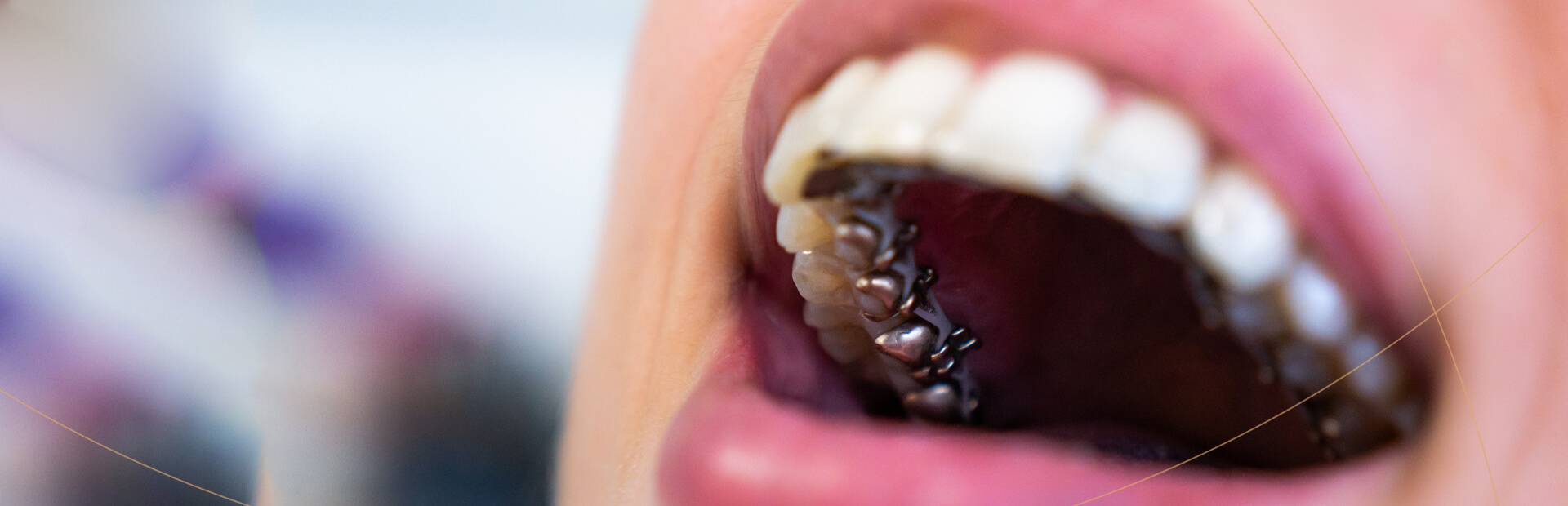Lingual Braces Brentwood, Essex - Smile HQ