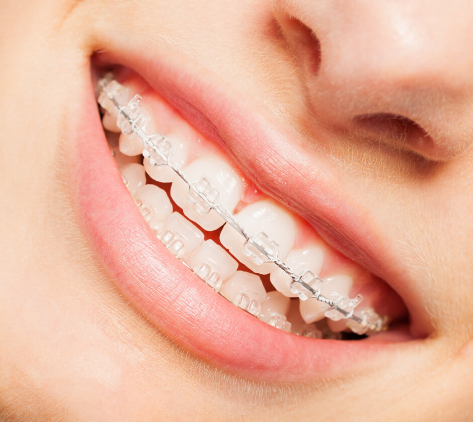 Fixed Braces Brentwood, Essex - Smile HQ