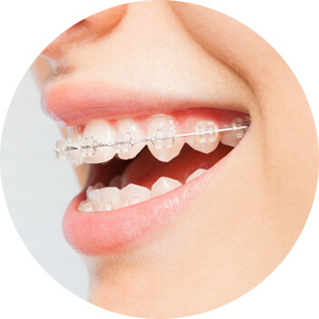 Fixed Braces Brentwood, Essex - Smile HQ