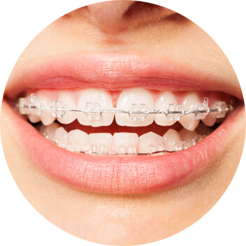 Fixed Braces Brentwood, Essex - Smile HQ
