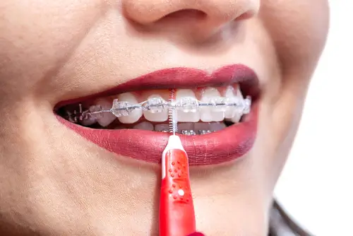 Woman using interdental brush to maintain hygiene around her fixed braces