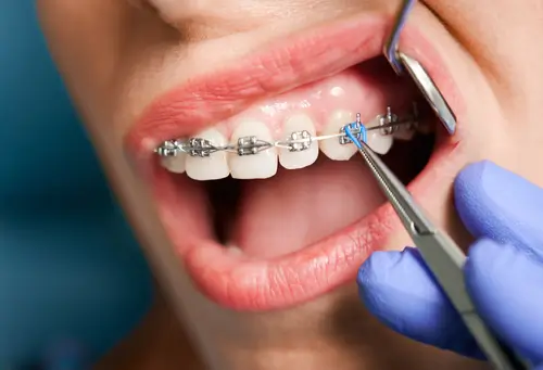 Dentist fitting fixed braces to a patients teeth