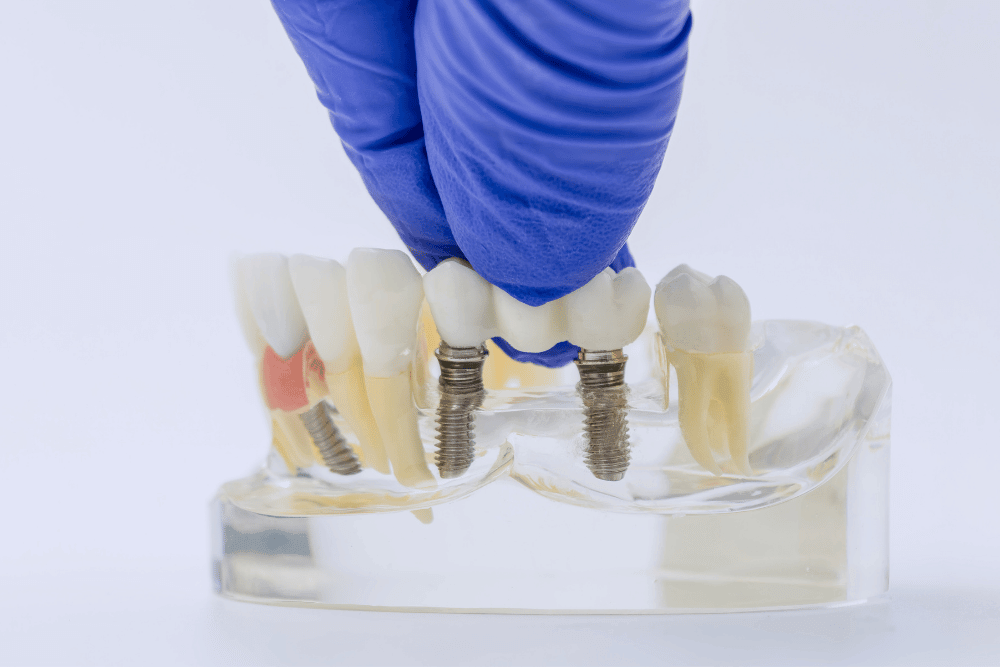 Educational model demonstrating how dental implants replace missing teeth